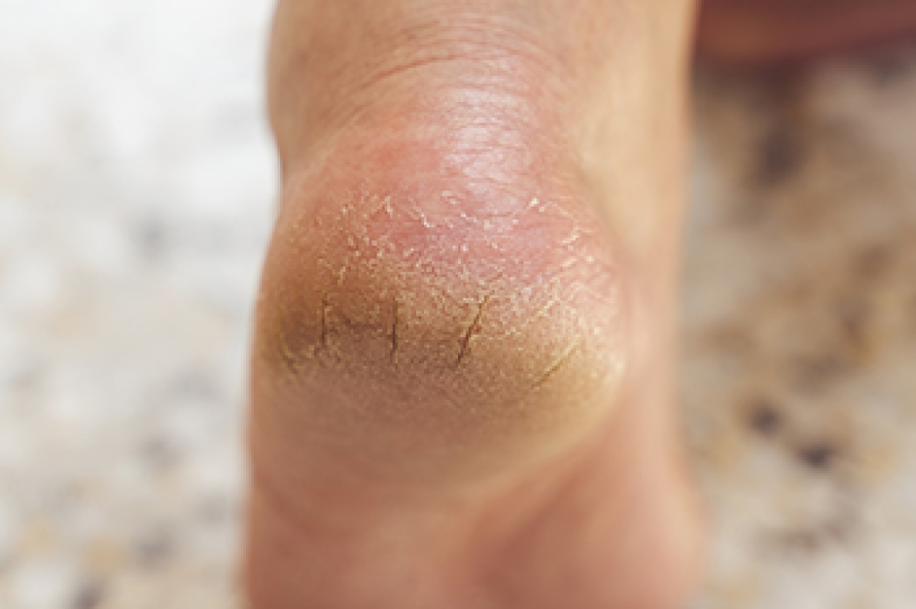 Cracked Heels Symptoms and Treatment
