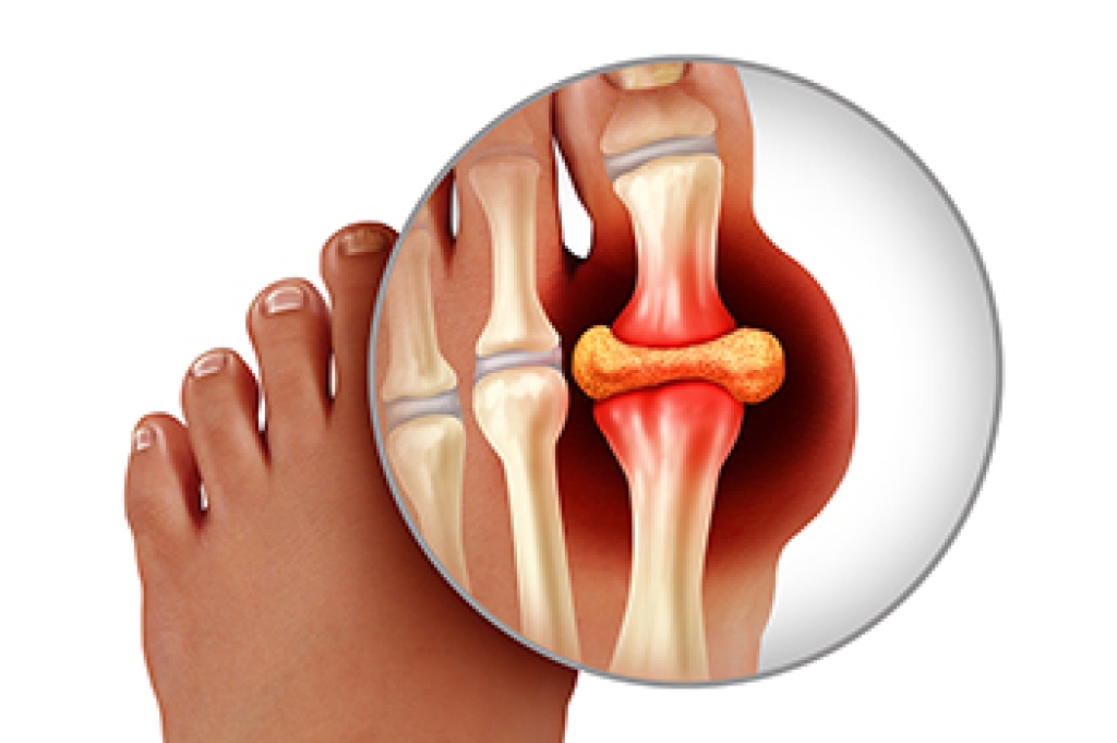 Gout and Pain in the Big Toe