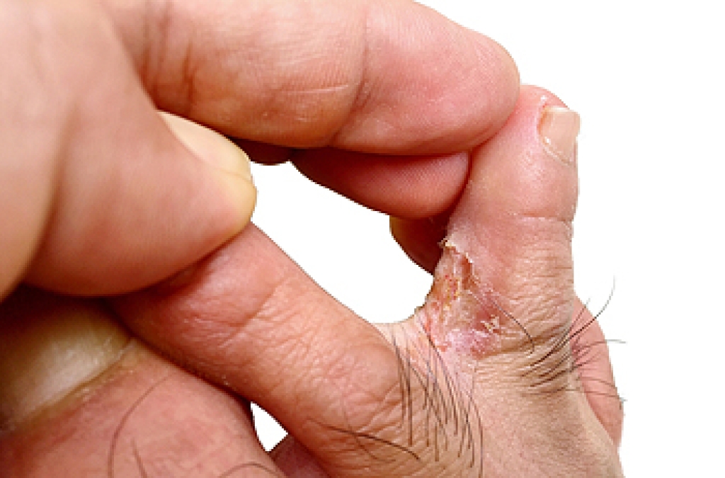 Athlete’s Foot Identification