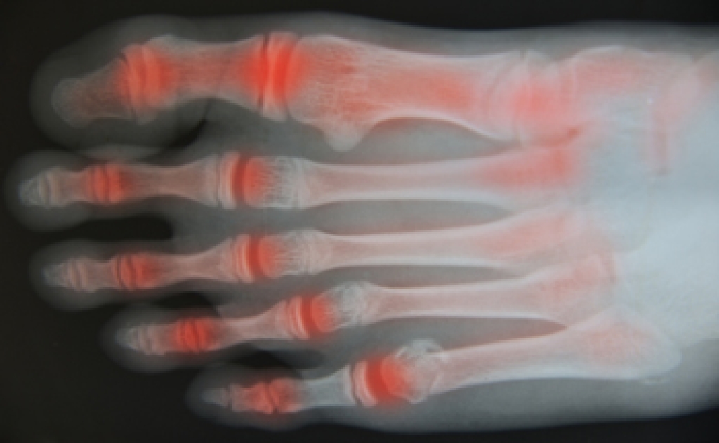 Ways That Rheumatoid Arthritis Affect the Feet