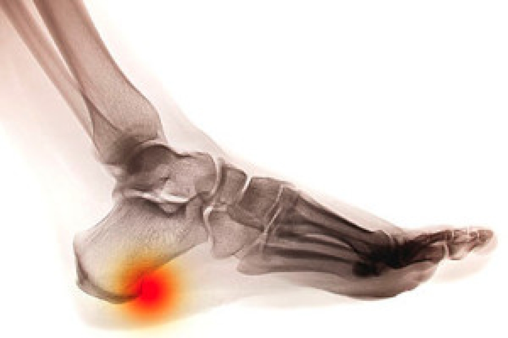 Heel Spurs and What Causes Them