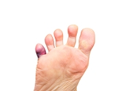 Causes and Symptoms of Pinky Toe Pain