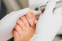 What Is Laser Therapy for Fungal Nails?
