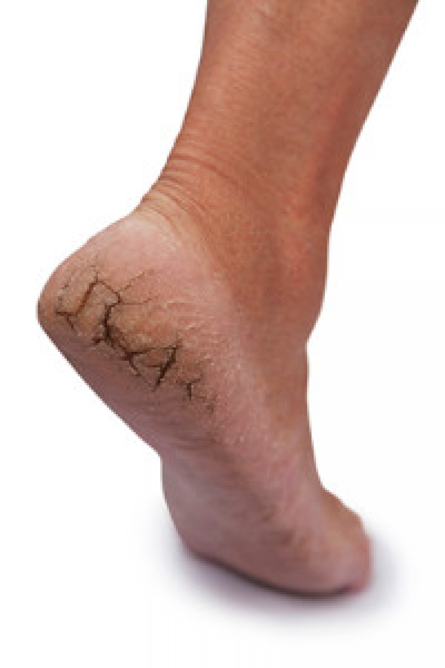 Risk factors for heel fat pad atrophy - footsurgeon