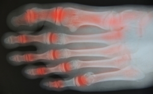 Types of Arthritis That Affect the Feet