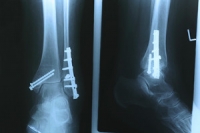 Foot and Ankle Stress Fractures